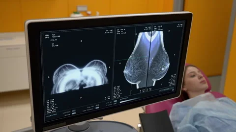 Screening test checkup identifies dangerous cancer cells in the woman breast Stock Footage 263273950