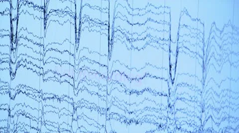 Scrolling through brain wave charts Stock Footage