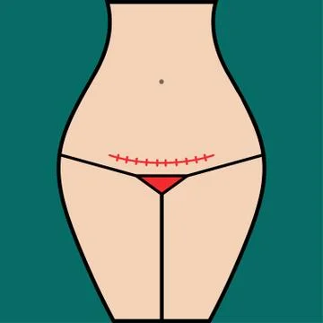 Seam after caesarean section Stock Illustration