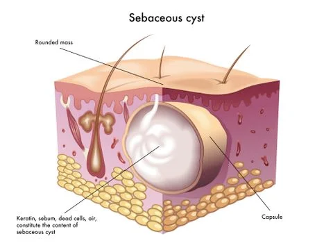 Sebaceous cyst Stock Illustration