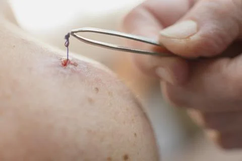 Second attempt to remove a forgotten retained suture or suture fragment fro.. Stock Photos