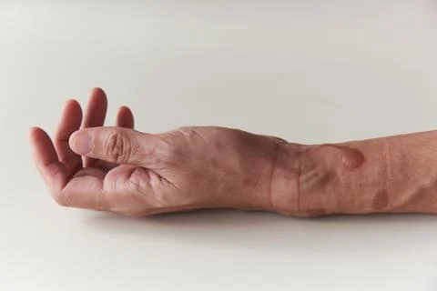 Second degree burn at left forearm and wrist Stock Photos