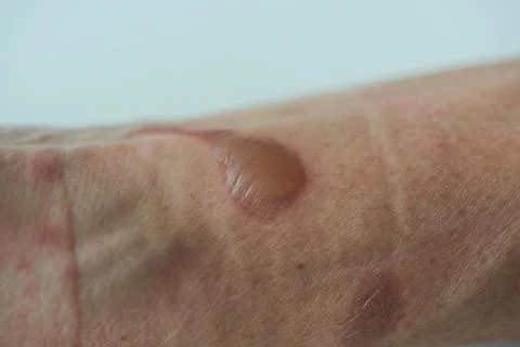 Second degree burn at left forearm and wrist Stock Photos