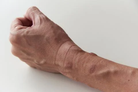 Second degree burn at left forearm and wrist Stock Photos
