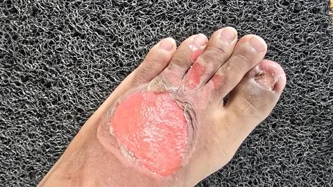 Second degree burns open wound, damage extends beyond the top layer of skin.. Stock Photos