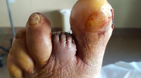 Second toe amputation wound with sutures in place Stock-Fotos