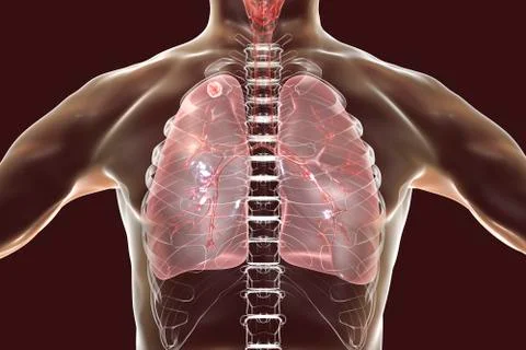 Secondary tuberculosis in lungs Stock Illustration