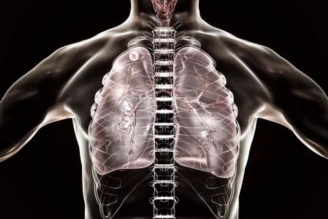 Secondary tuberculosis in lungs Stock Illustration