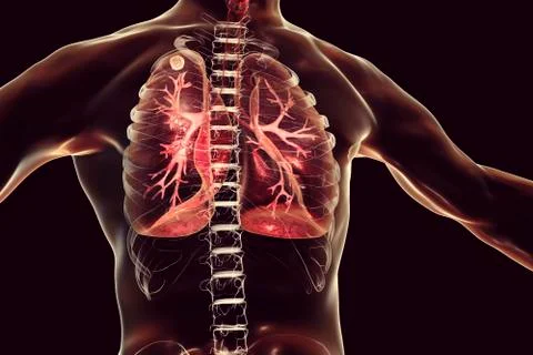 Secondary tuberculosis in lungs Stock Illustration