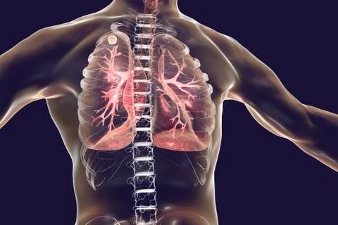 Secondary tuberculosis in lungs Stock Illustration