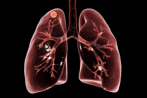 Secondary tuberculosis in lungs Stock Illustration