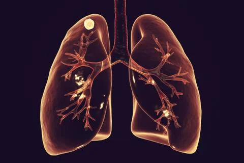 Secondary tuberculosis in lungs Stock Illustration