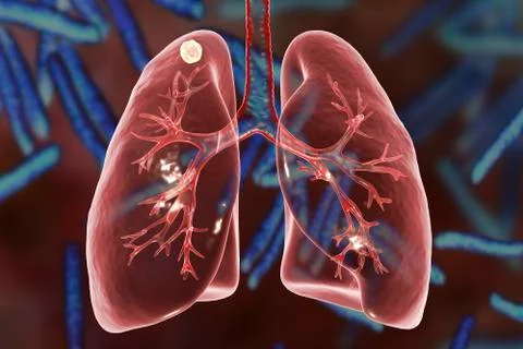 Secondary tuberculosis in lungs Stock Illustration