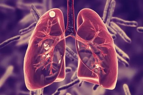 Secondary tuberculosis in lungs Stock Illustration