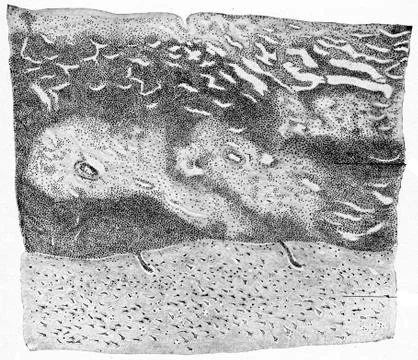 Section of cerebral cortex and meninges from a case of suppurative meningitis Stock Illustration