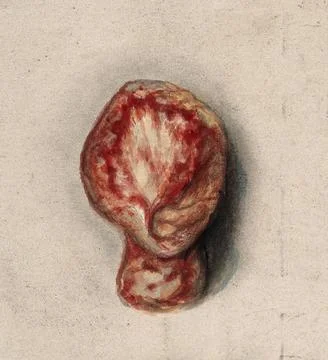 Section of a testicle removed from a man suffering from tertiary syphilis. .. Stock Illustration
