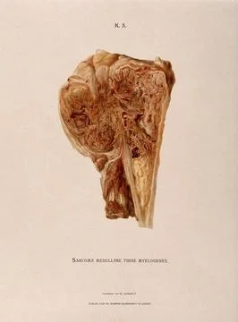 Section through part of a tibia bone, showing diseased tissue and a cancero.. Stockillustratie