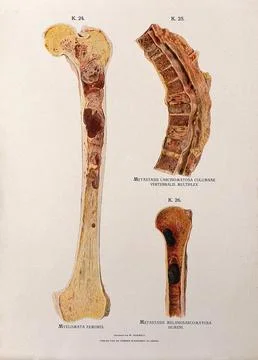 Sections through diseased femor, spinal and humerus bones: three figures. C.. Illustrazione stock