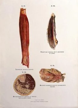 Sections through diseased muscles: four figures. Chromolithograph by W. Gum.. Stock Illustration