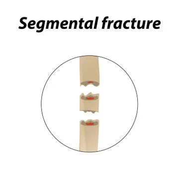 Segmental fracture Bone. Infographics. Vector illustration on a lined background Illustrazione stock