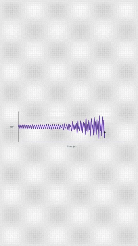 Seizure Onset Clean No Text EEG Brain Wave Alpha 4K Vertical 9x16 Light Stock Footage 339493868