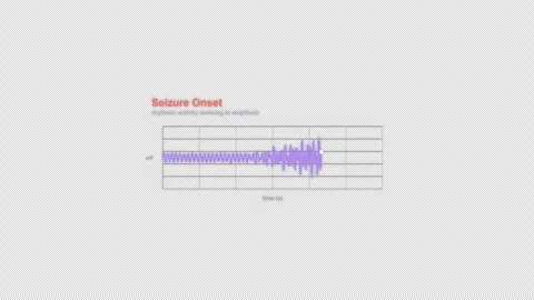 Seizure Onset EEG Brain Wave Animation Labeled Video Overlay Alpha 4K Видео 339303688