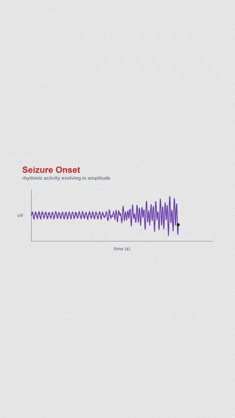 Seizure Onset Labeled EEG Brain Wave Alpha 4K Vertical 9x16 Light Stock Footage 339493894