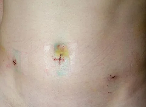 Selective focus abdominal scars after invasive inguinal hernia surgery. Stock Photos