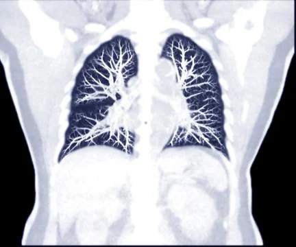 Selective Focus of CT Chest Coronal MIP view for diagnostic Pulmonary embolis Stock Illustration