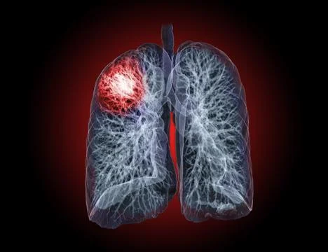 Selective focus of CT Chest or Lung 3D rendering image on the monitor  for di Stock Illustration