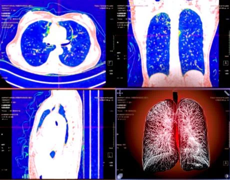 Selective focus of CT Chest or Lung 3D rendering image on the monitor  for di Stock Illustration