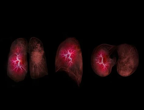 Selective focus of CT Chest or Lung 3D rendering image for diagnosis  lung di Stock Illustration