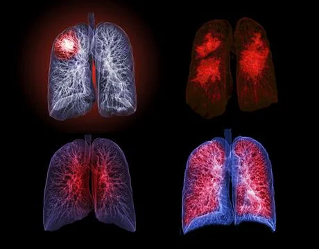 Selective focus of CT Chest or Lung 3D rendering image on the monitor  for di Illustrazione stock