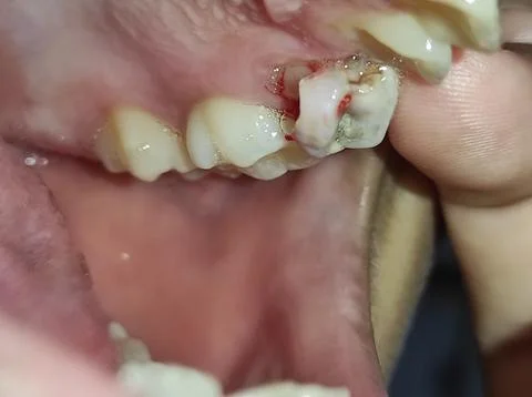 Selective focus of impacted wisdom teeth. Stock Photos