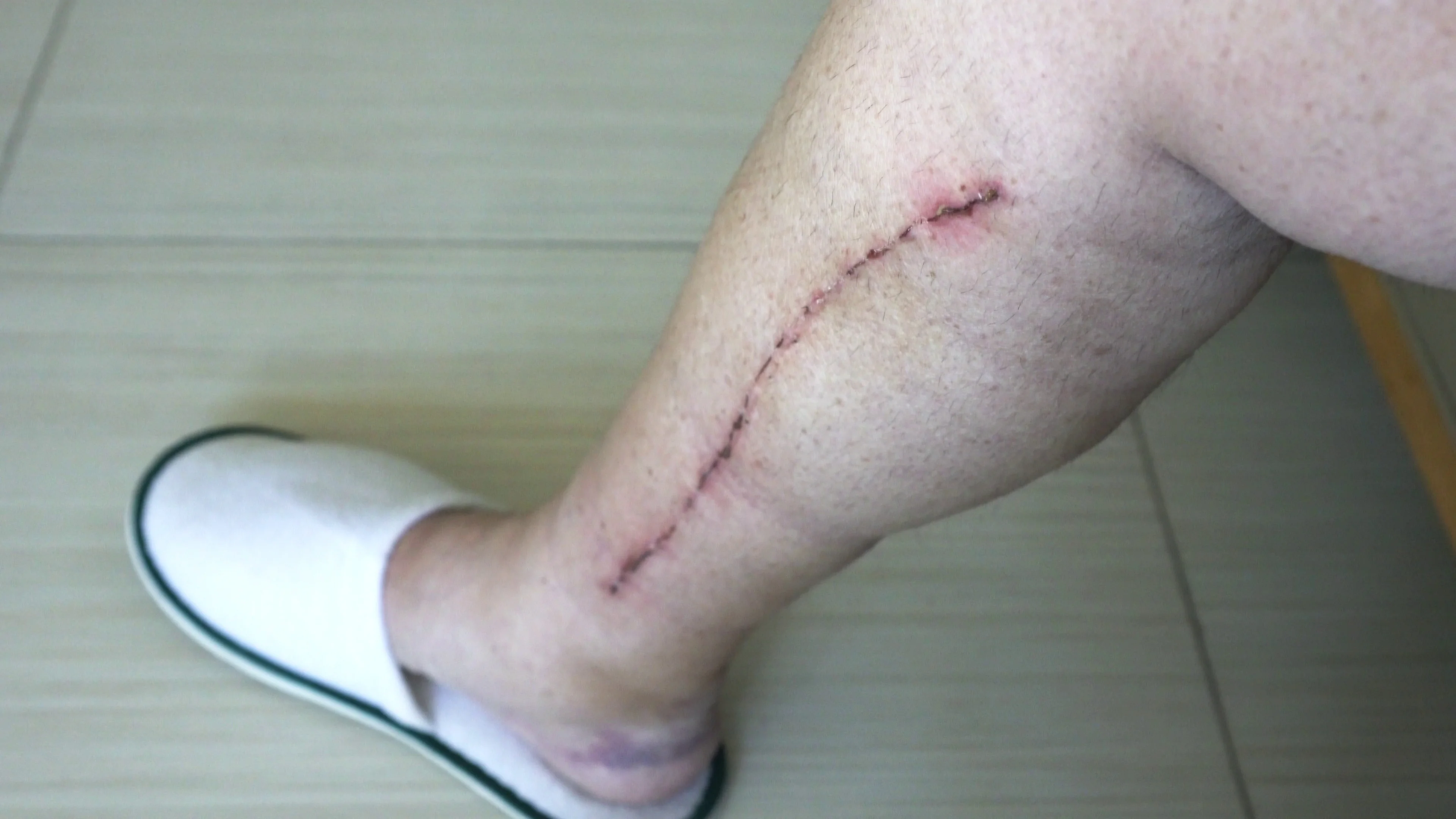 Scars on the legs of men. Selective focus of male human leg with