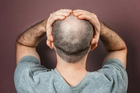 Self-doubt and inferiority complex. Baldy adult man grabs his head with his h Stock Photos
