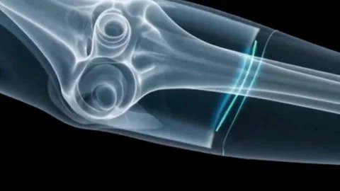 Semi-transparent X-ray image of a human forearm in profile, Stock Footage 340318404