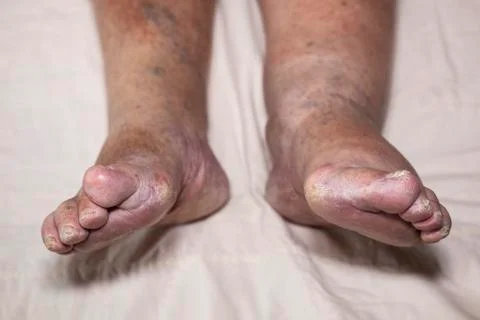 Senior leg problems Stock Photos