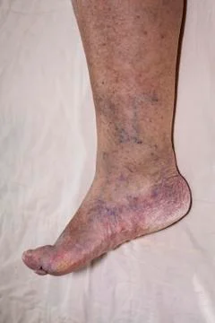 Senior leg problems Stock Photos