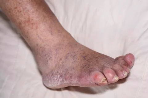 Senior leg problems Stock Photos