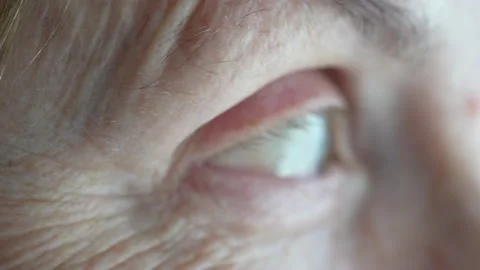 Senior woman's eyes with problem, closeup of irritated red bloodshot eye Stock Footage 172301664