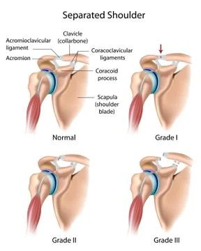 Separated shoulder Stock Illustration