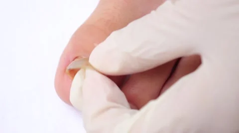 Separation from the nail bed Vídeo Stock 57332984