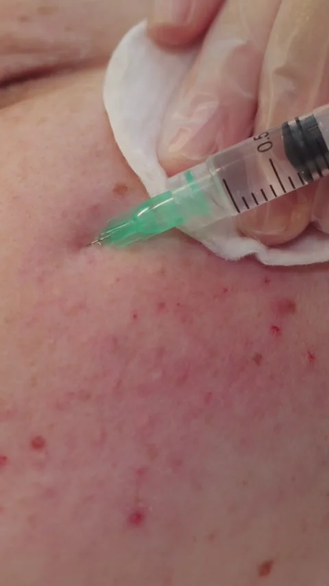 Session with a dermatologist - the therapist injecting a solution under the skin Stock Footage 328444844
