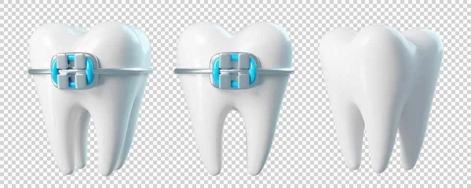 Set of 3d teeth with braces Stock Illustration
