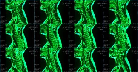 Set of 6 sagittal green colored MRI scans of neck area of caucasian 34 years old Stock Illustration