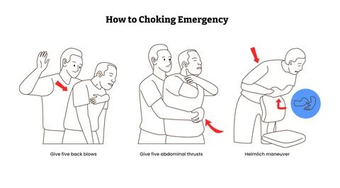 Set of Choking first aid infographic poster design for adult rescue, Heimli.. Stock Illustration