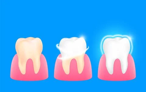 Set of  clean and dirty tooth. Step of yellow to white. Dental care concept. Stock Illustration