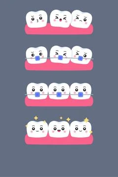 Set of cute flat cartoon tooth characters showing orthodontic treatment sta.. Stock Illustration
