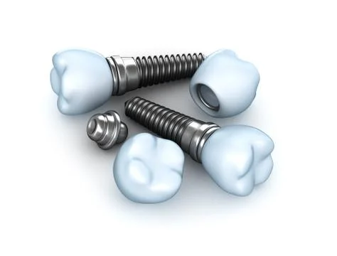 Set of dental implants Stock Illustration